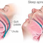 Air Purifiers Help Treat Sleep Apnea A CPAP Alternative –